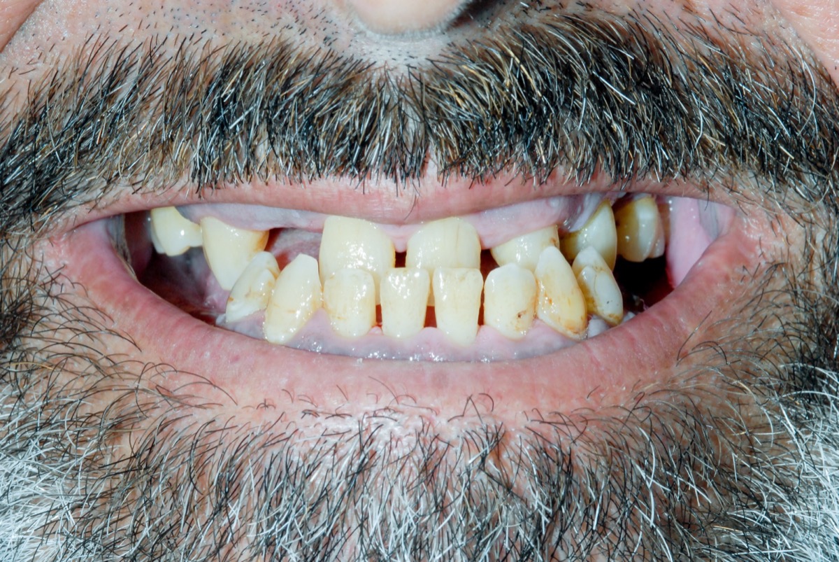Before — Upper & lower cross-bite; lots of missing teeth; Inability to chew properly