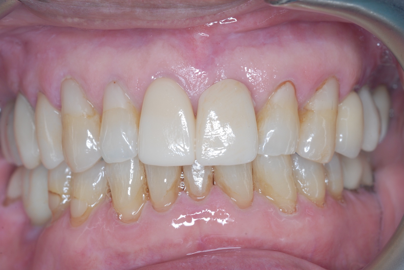 After — immediate placement, same-day provisional
