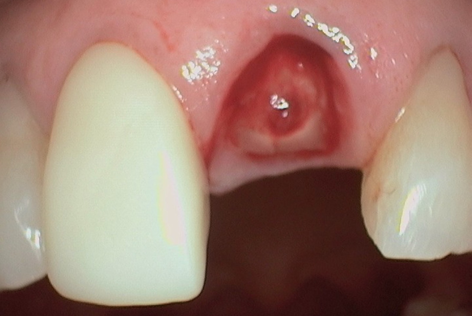 Before — immediate placement, same-day provisional