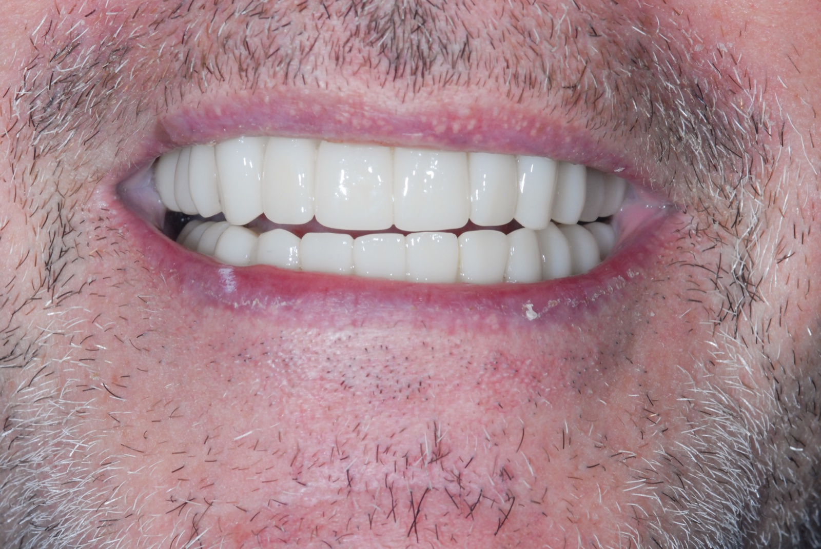 After — implant bridge, three units on two implants