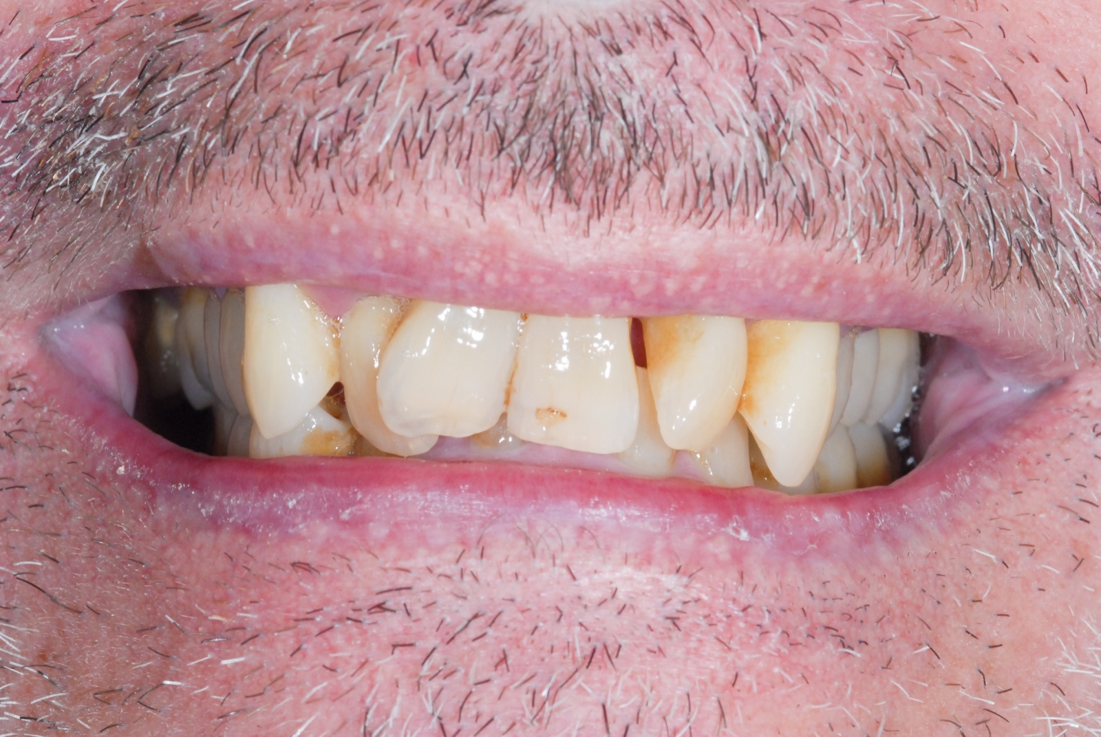 Before — implant bridge, three units on two implants