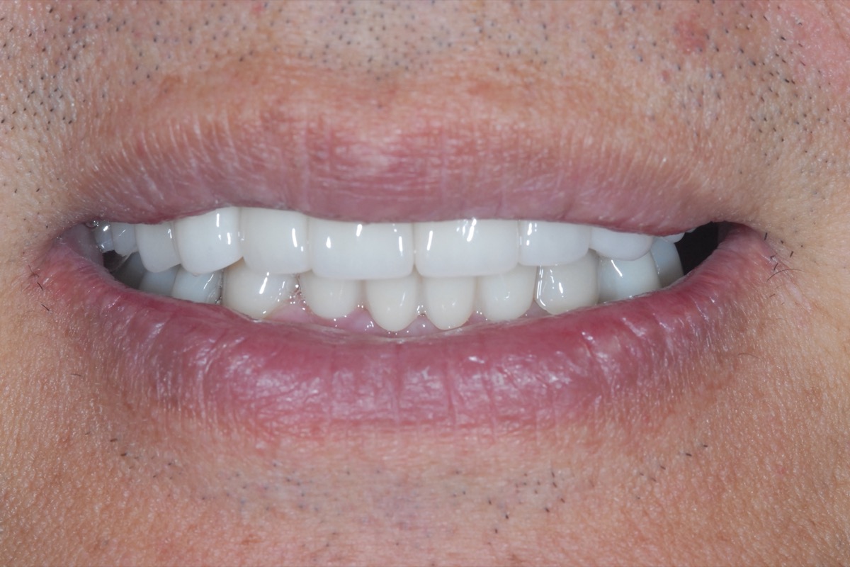 After — implants and crowns together restoring the upper and lower arches