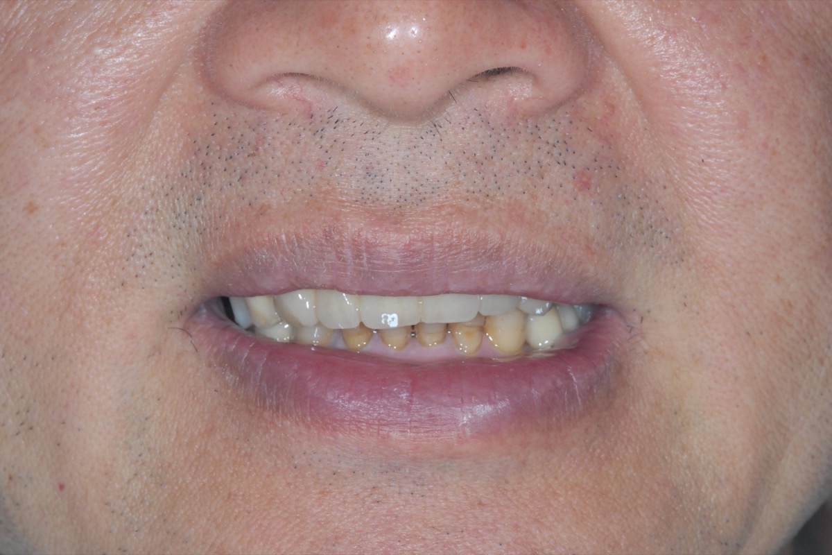 Before — teeth failing across both arches, several already lost