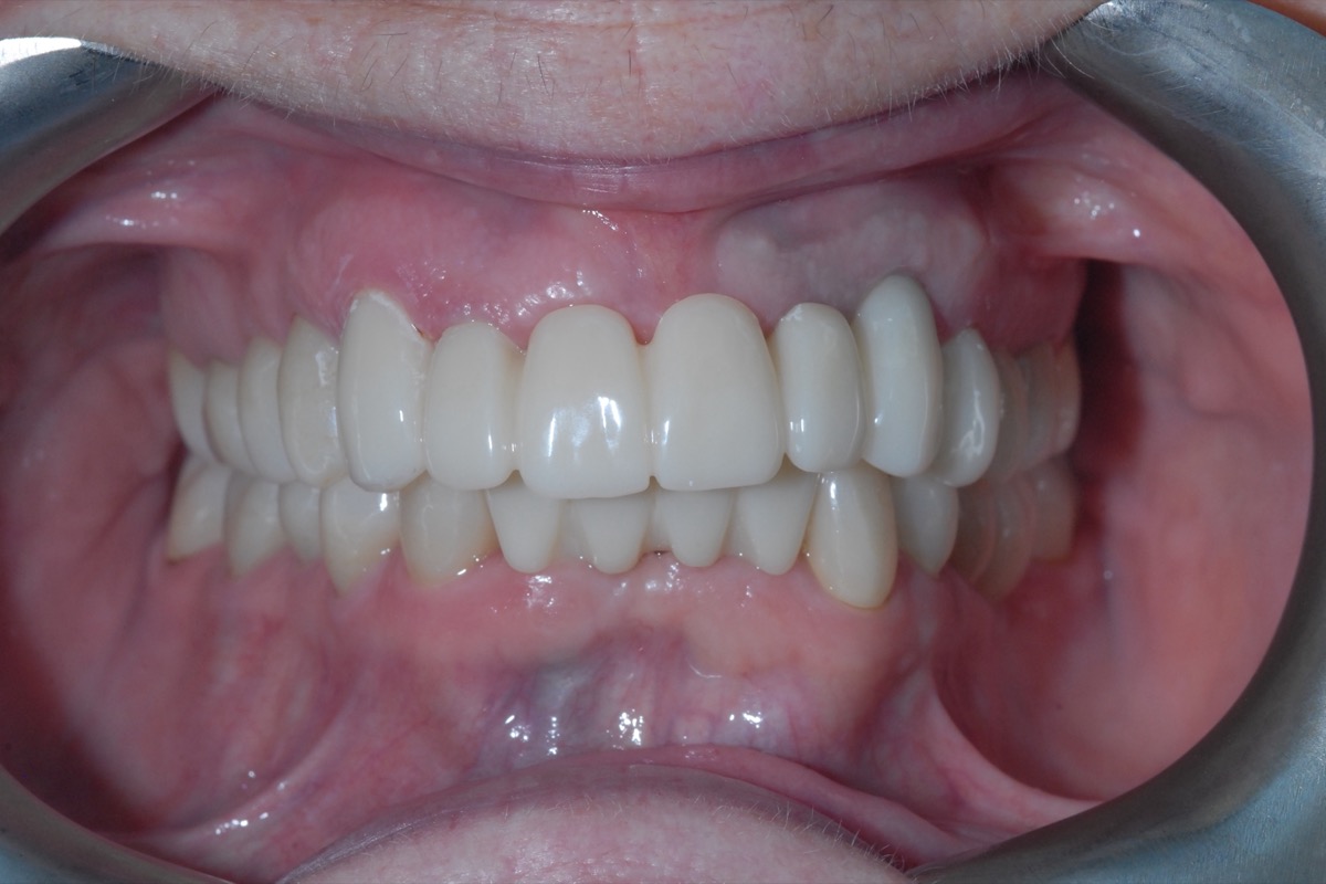 After — implants replacing what was lost, with crowns on the teeth that remained