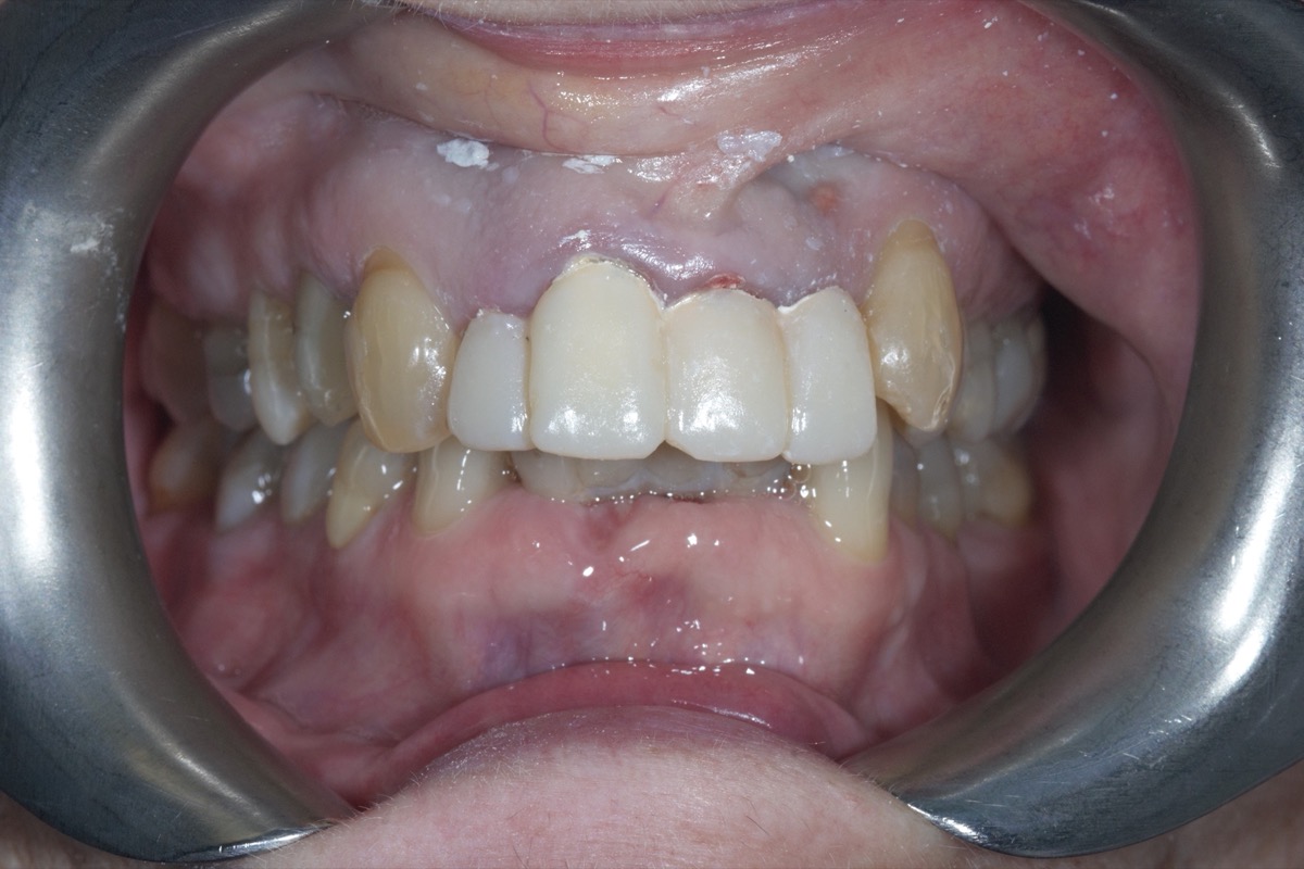 Before — missing and broken-down front teeth with staining along the gum line