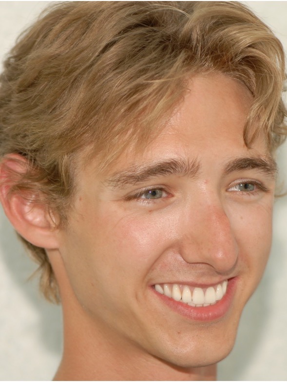 After — photographed in daylight after a haircut, smiling with the restored teeth