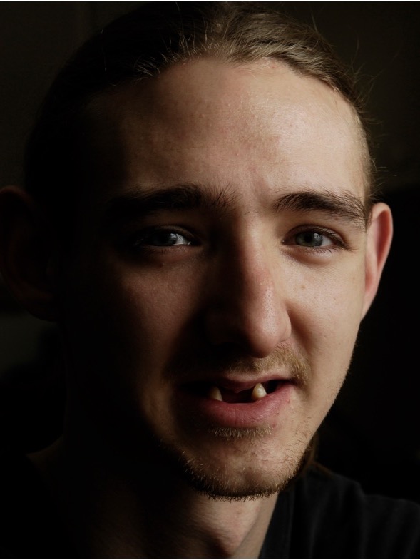 Before — photographed in low light with long hair, the front teeth broken and missing