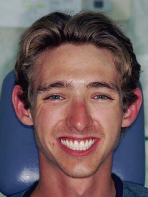 After — the same appointment with the teeth placed, the smile full and the face supported again