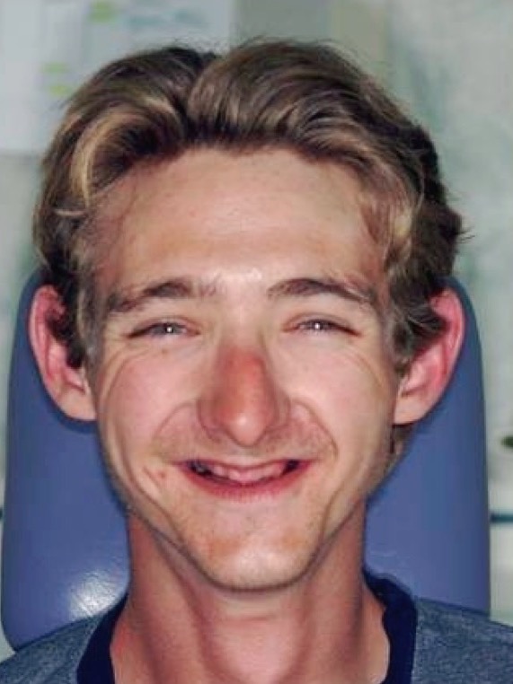 Before — in the chair without his teeth, the mouth collapsed inward and the lower face shortened