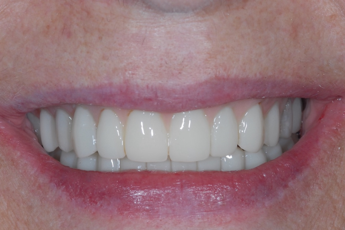 After — implants placed and teeth fitted the same day, the arch complete