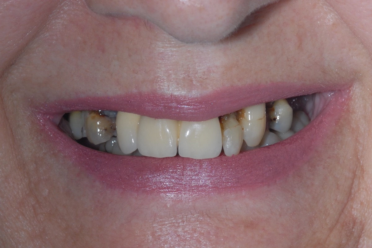 Before — a failing dentition, the remaining teeth broken and darkened