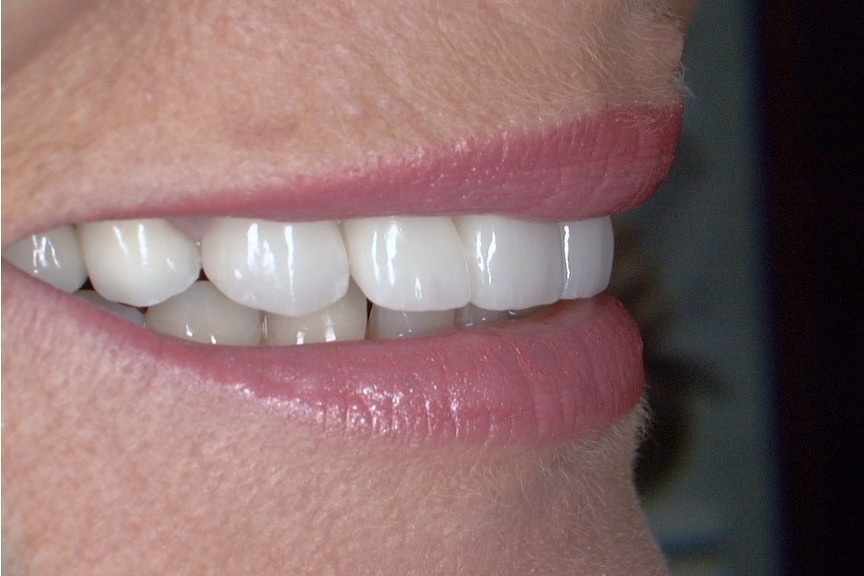 After — seen from the side, the restored teeth follow the curve of the lip