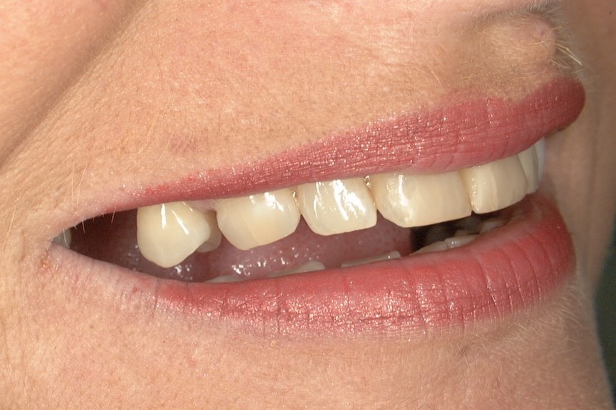 Before — seen from the side, the upper teeth sit flat and short against the lip
