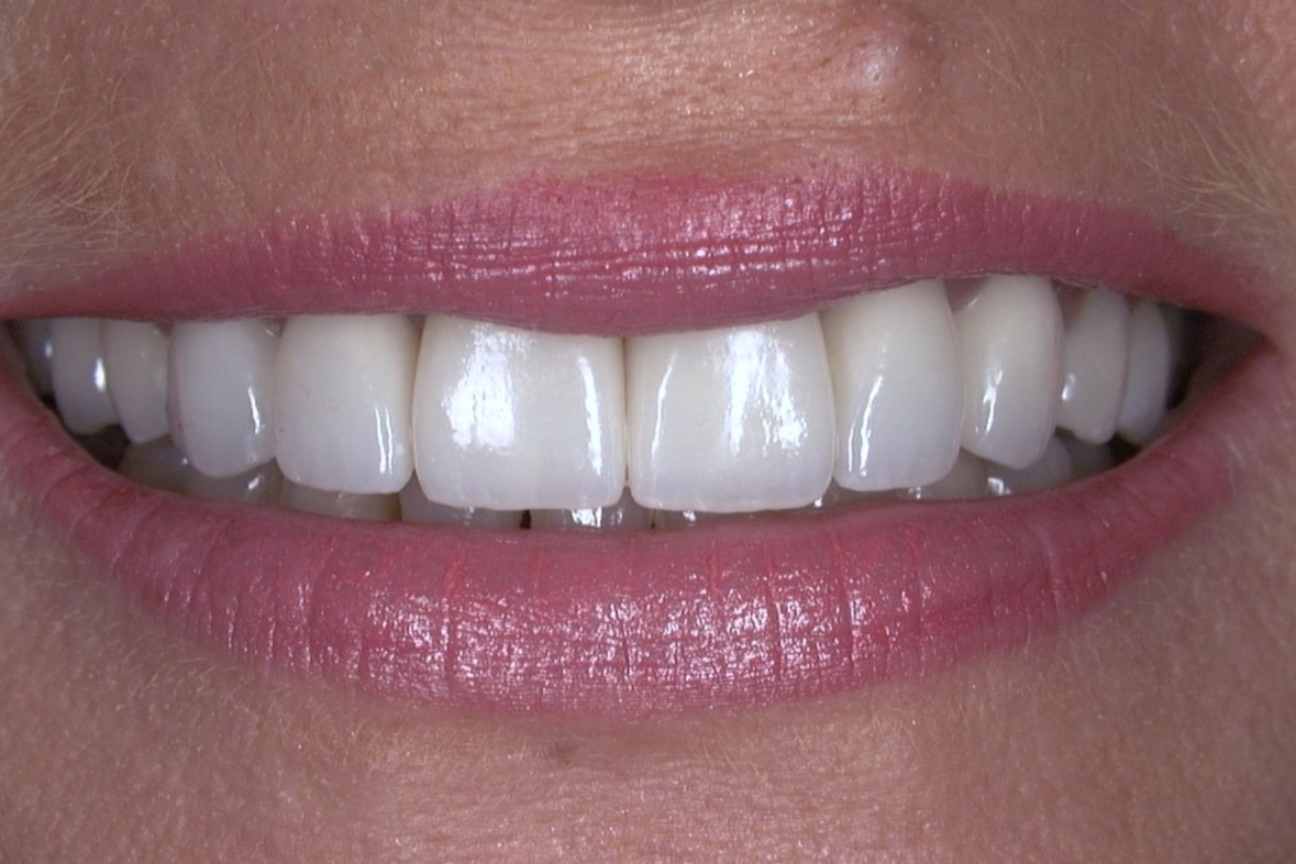 After — ten crowns and veneers, even in shade and restored in length