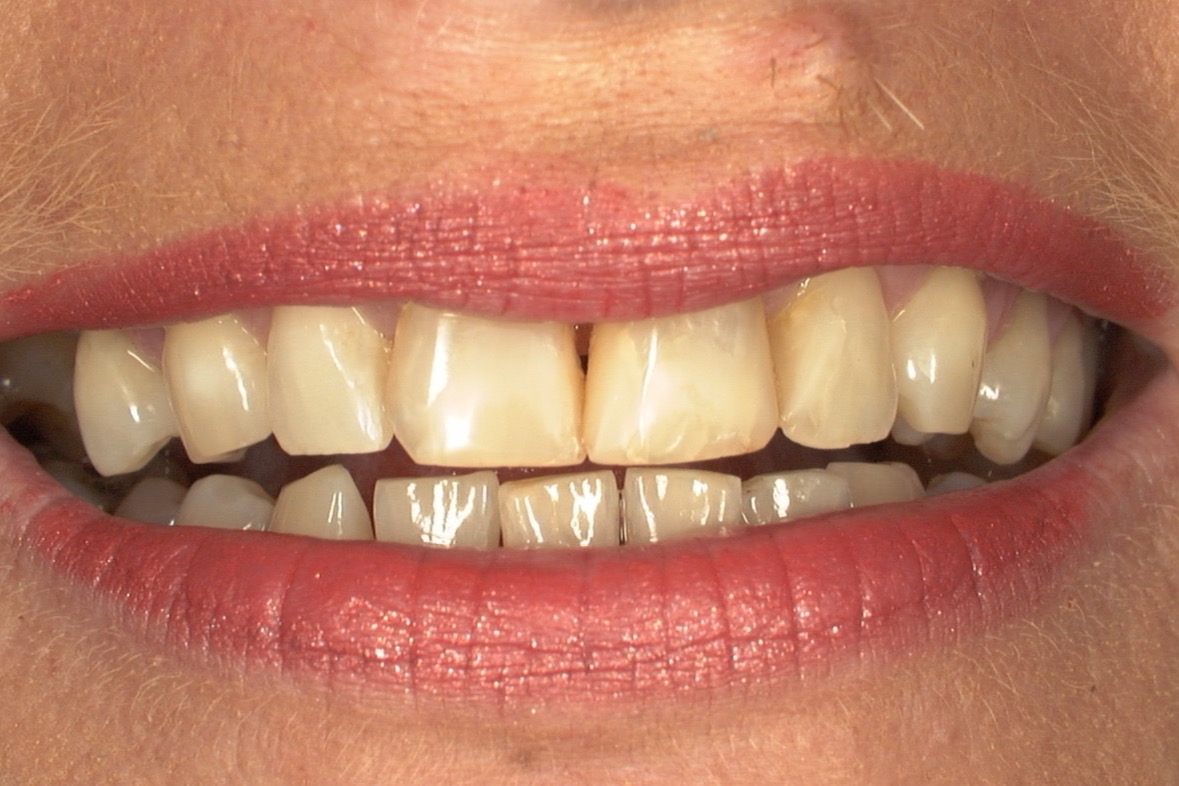 Before — upper front teeth yellowed, short and uneven along the biting edges