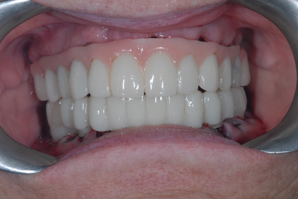 After — temporary teeth fitted to the implants the same day, upper and lower
