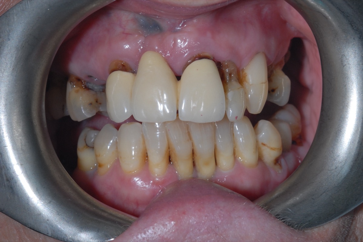 Before — failing crowns and loose teeth with gaps between them, at the end of their life