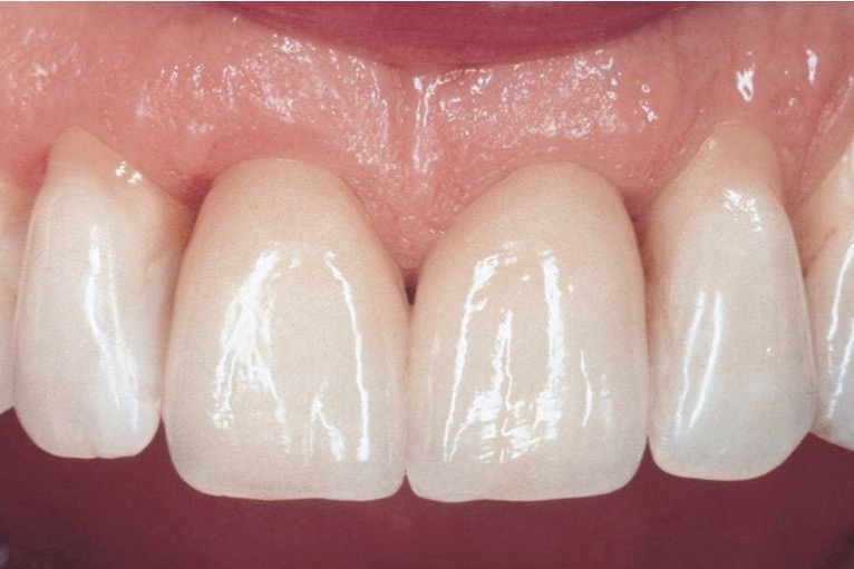 After — two all-porcelain crowns matching the neighbouring teeth in shade and translucency