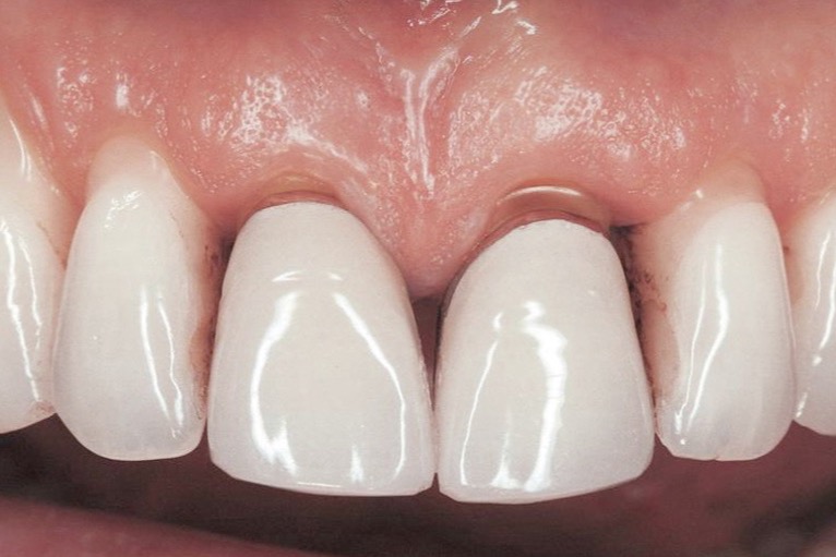 Before — two front crowns flat and opaque in appearance, with a dark line at the gum