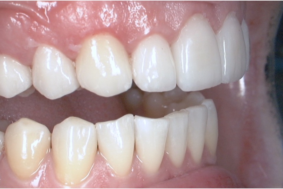 After — close on the front teeth, the edges even and the surfaces uniform