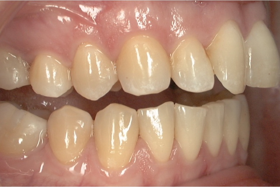 Before — close on the front teeth, the edges chipped and set at differing angles