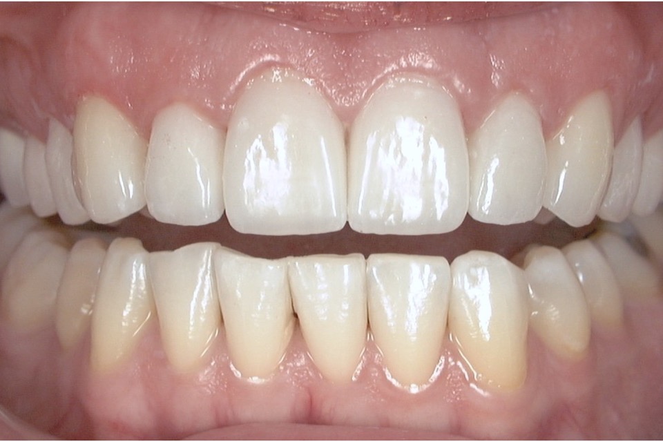 After — with the lips held back, the restored teeth meet evenly across the arch