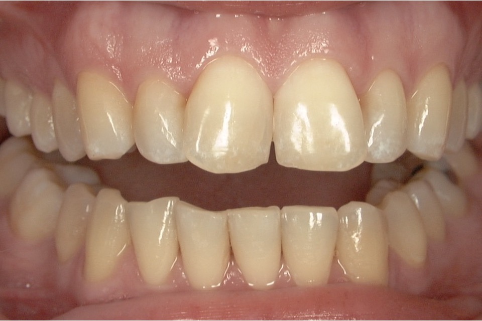 Before — with the lips held back, the upper and lower front teeth meet unevenly
