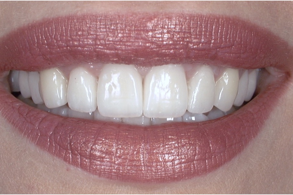 After — upper front teeth even in line and shade across the smile