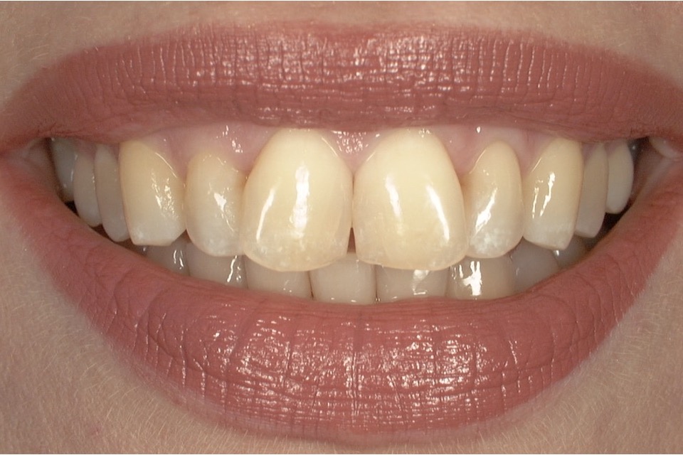 Before — upper front teeth out of line with one another and yellowed in shade
