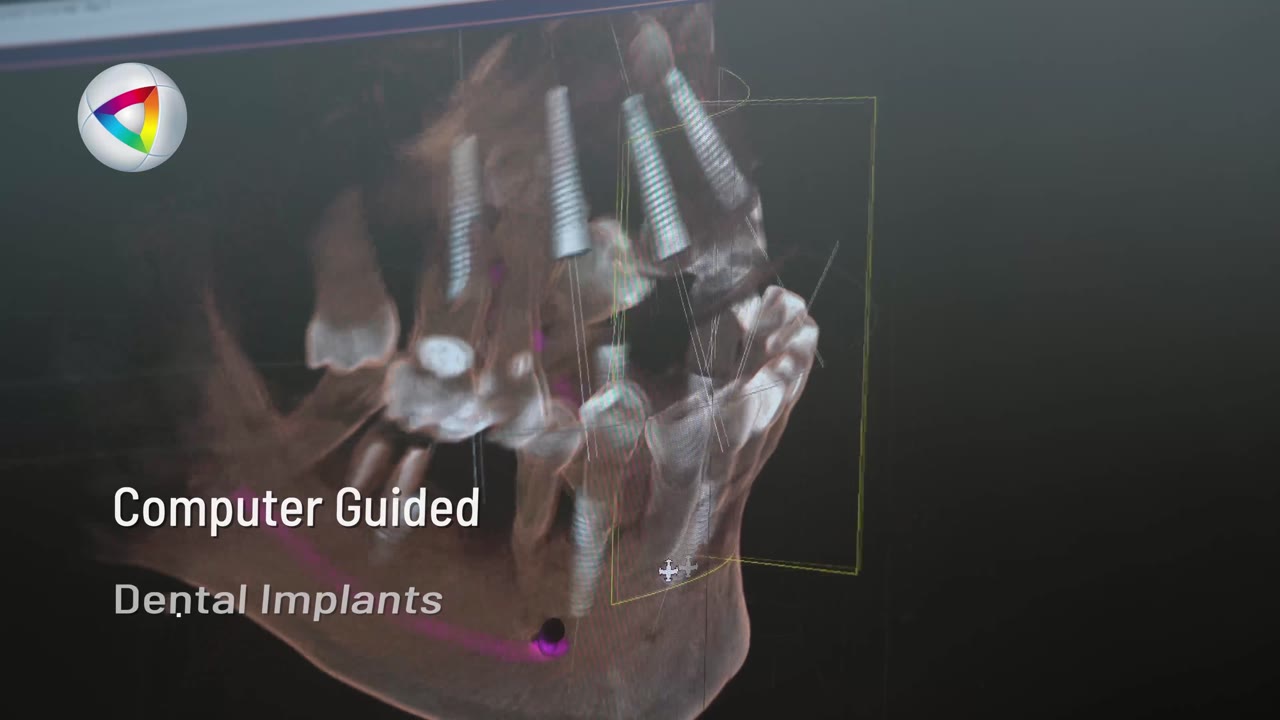 Implants being planned on a 3D CBCT scan of the jaw, shown on screen with the caption Computer Guided Dental Implants