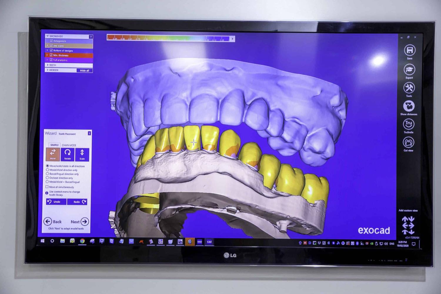 Full-arch restoration being designed in the practice's in-house digital laboratory