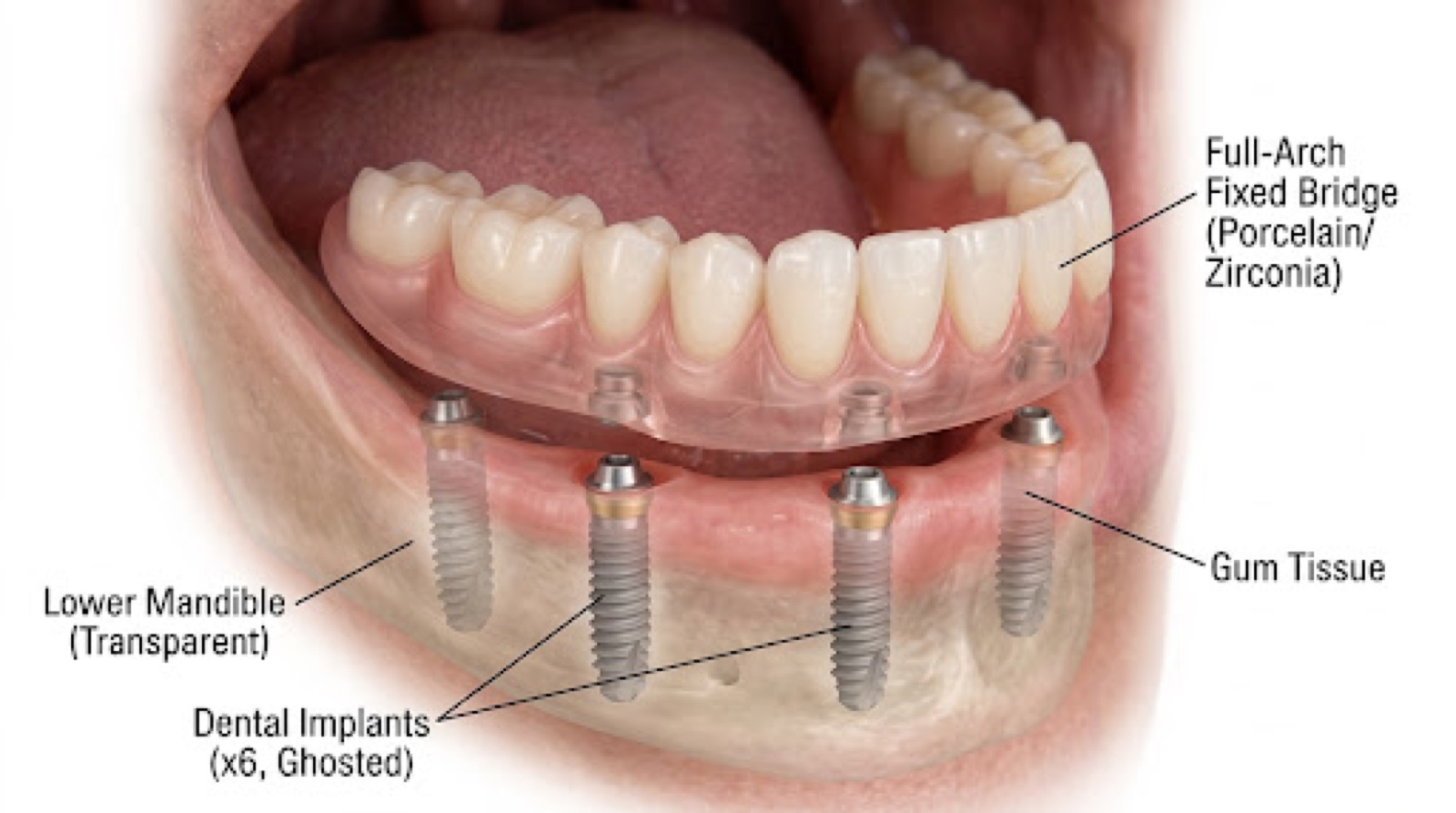 Illustration of a full-arch fixed bridge on six implants, with each part labelled: the porcelain or zirconia bridge, the dental implants in a transparent lower jaw, and the gum tissue