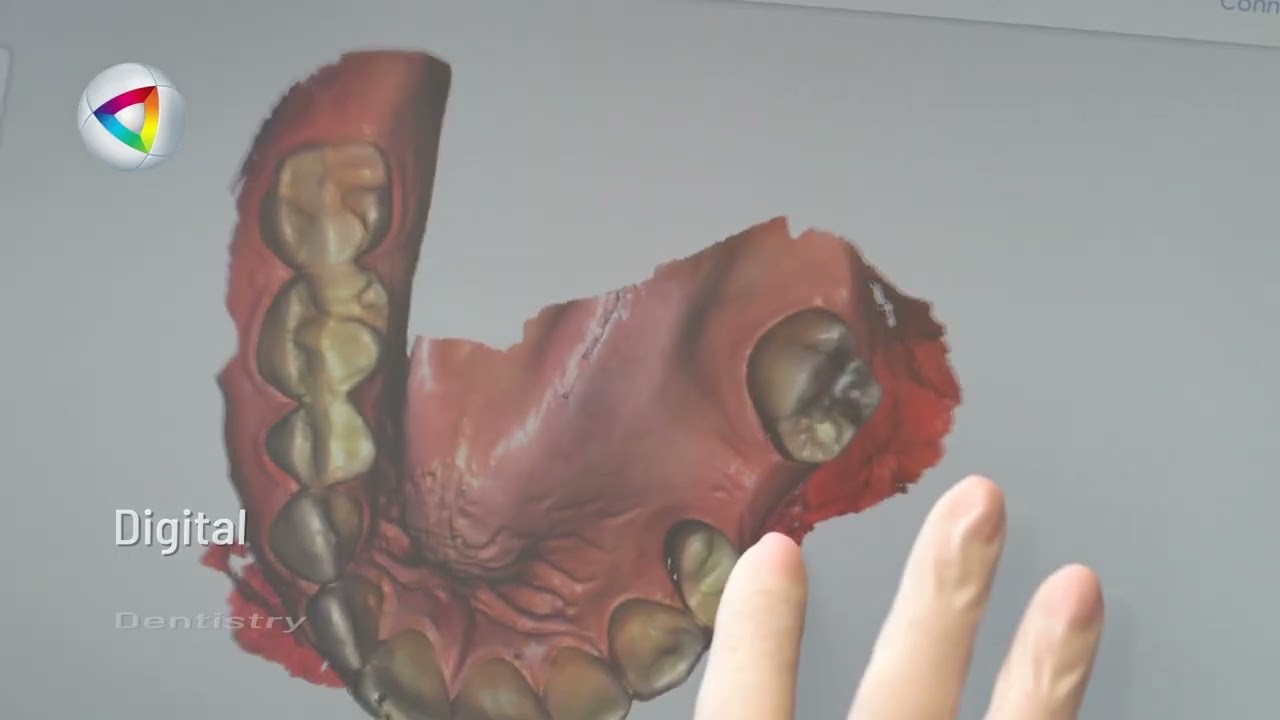 A three-dimensional dental scan displayed on a screen