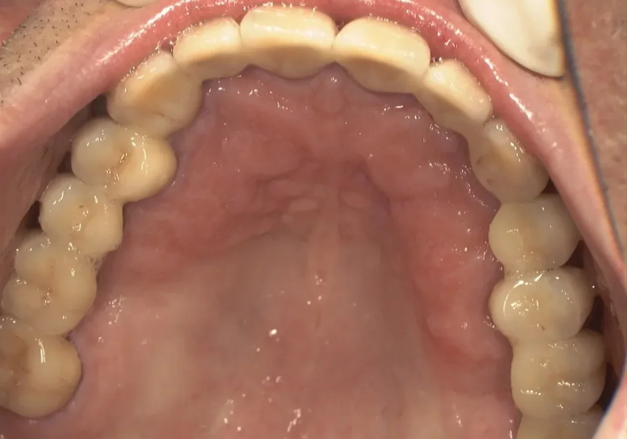 After implant-supported bridge