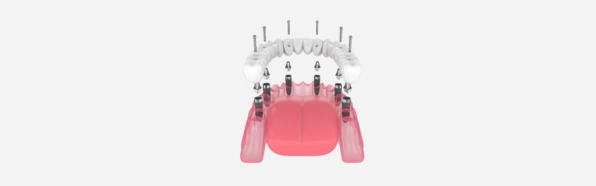 Full Mouth All-On-6 Dental Implants – Case of the week.