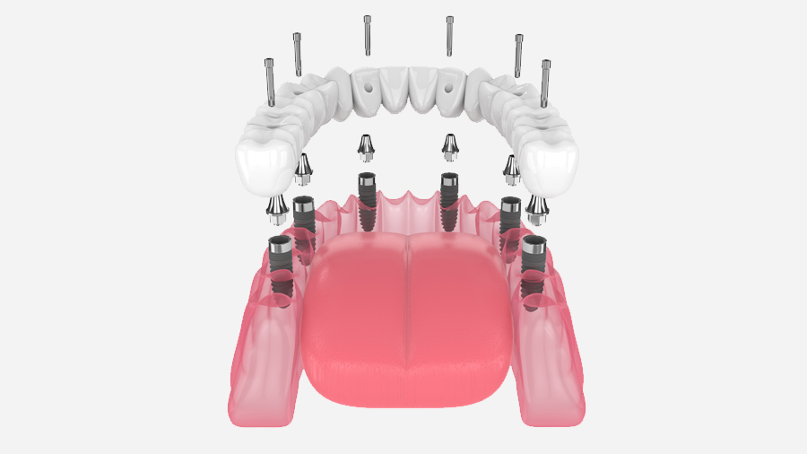 Full Mouth All-On-6 Dental Implants – Case of the week.