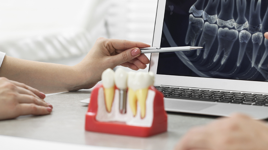 Case of the week- Transforming Smiles with Vitality Dentistry’s Computer Guided Dental Implant Solutions