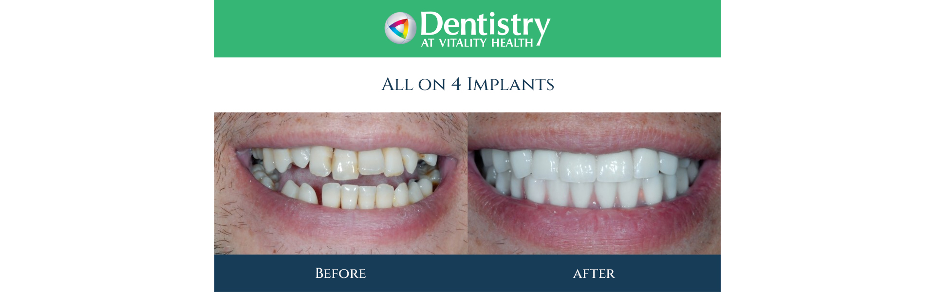 All on 4 Implants in Markham