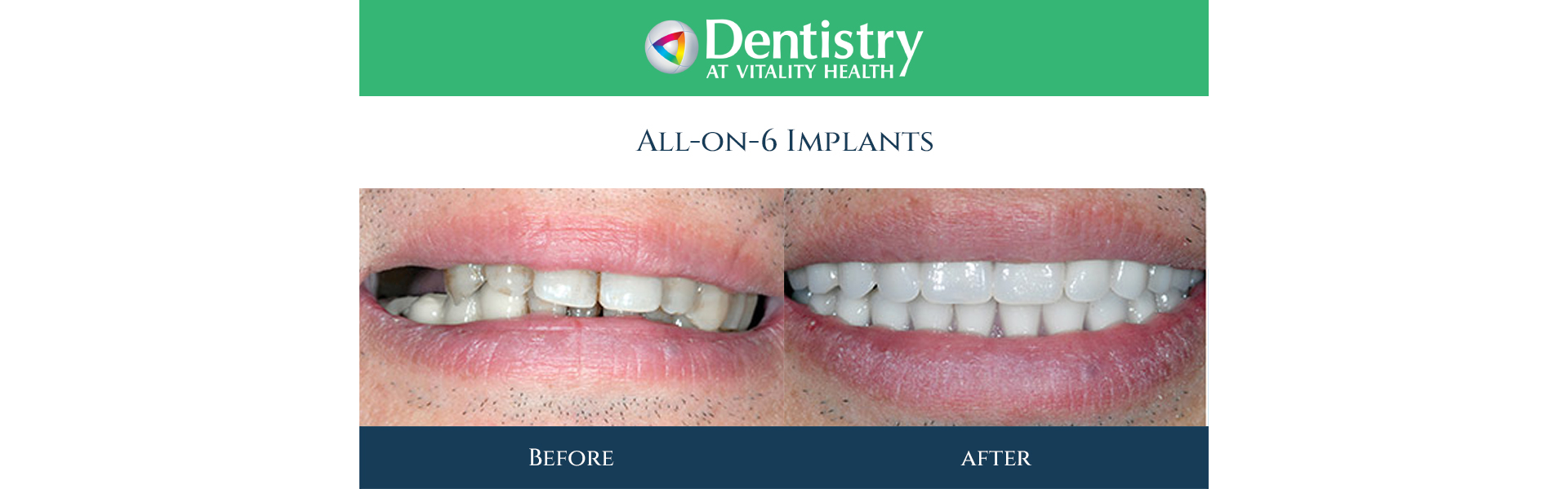 All-on-6 Implants in Markham, ON