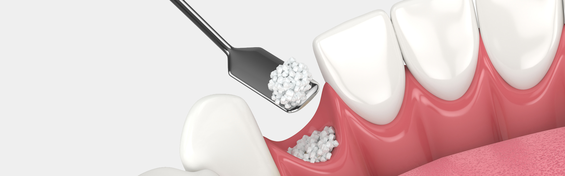 Bone Grafting & Sinus Lifts in Markham, ON