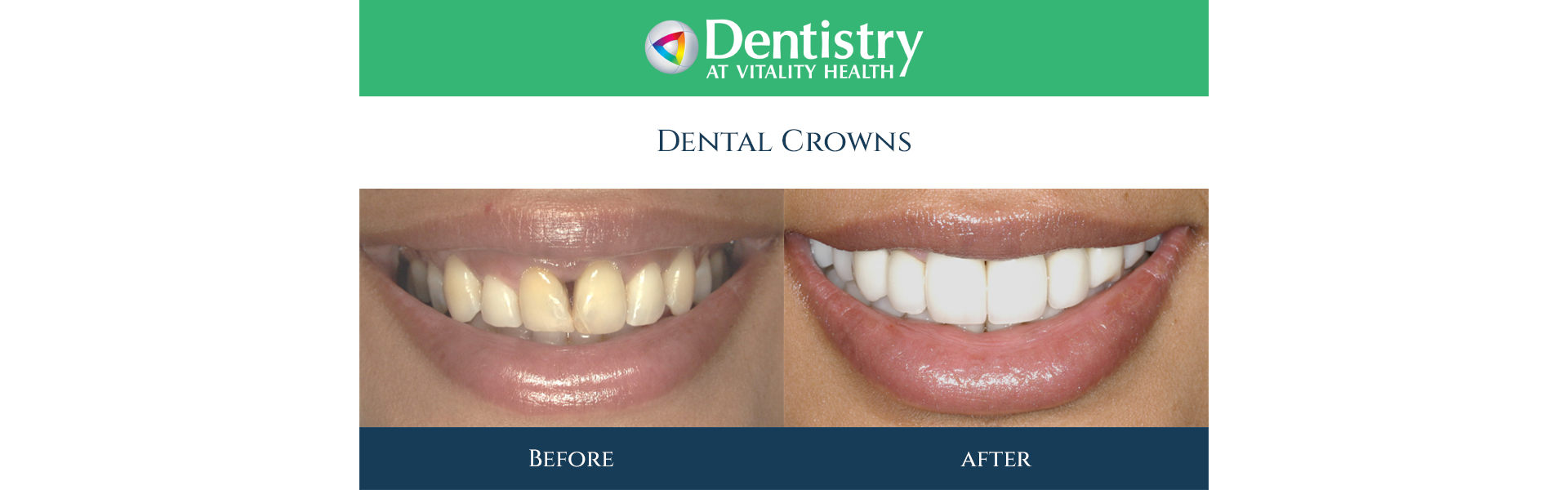 Same-Day Crowns in Markham