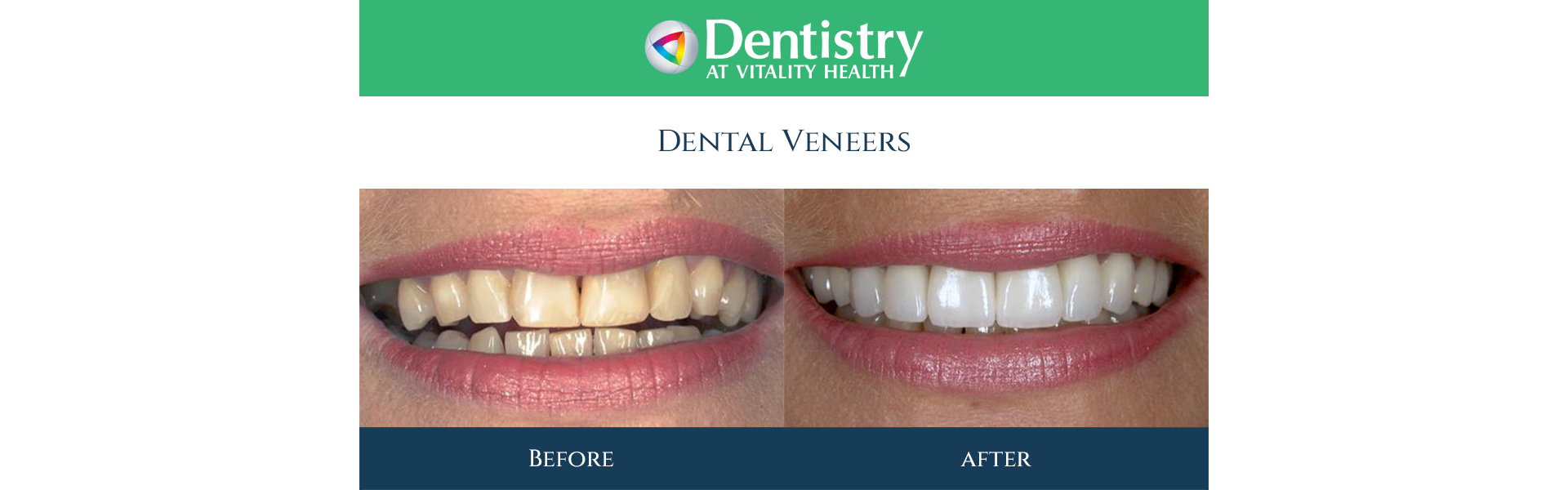 Dental Veneers in Markham