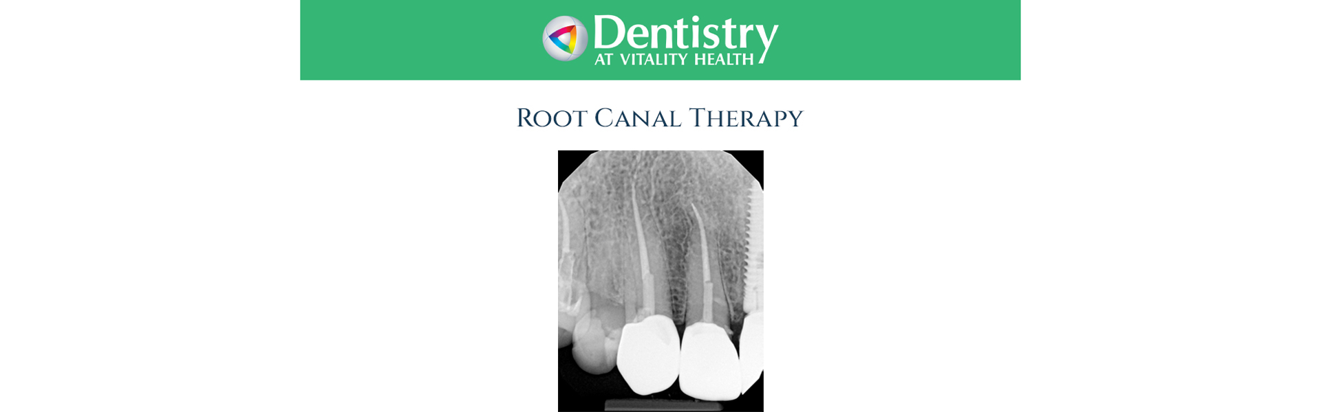 Root Canal Therapy for Markham