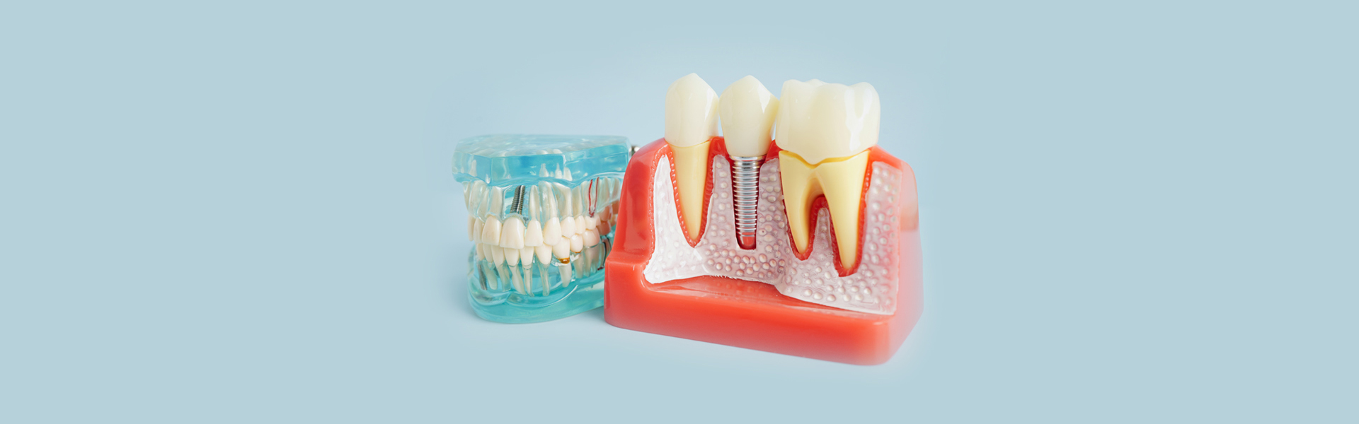 What to Expect During the Dental Implant Process