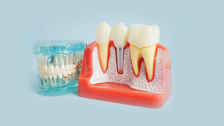 What to Expect During the Dental Implant Process
