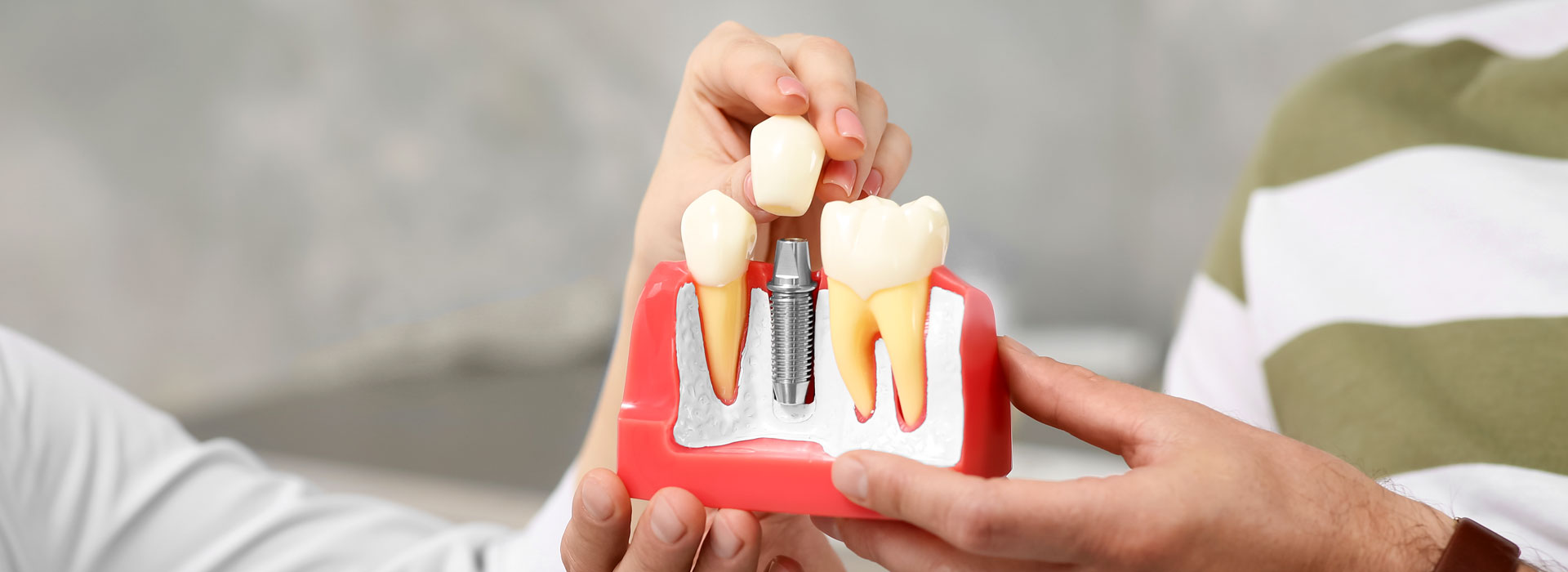 Dental Implants