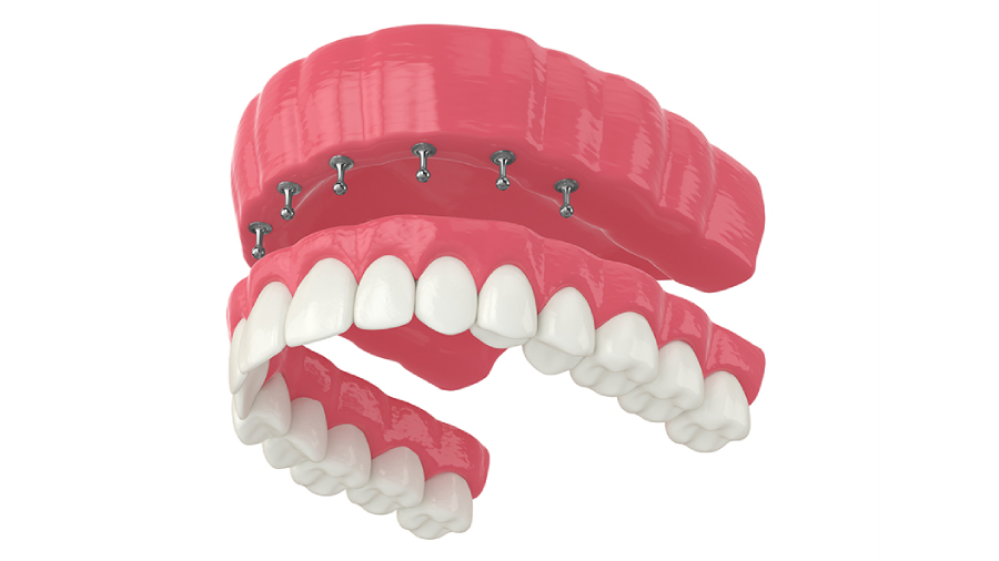 What Are All-on-6 Implants and Who Are They For?